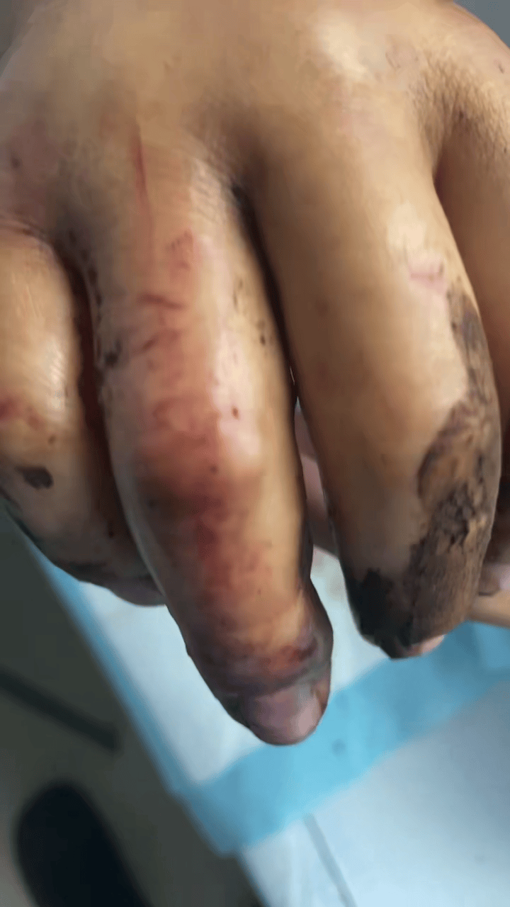 丹麦丙组联赛_男子被毒蛇咬伤拦车自救丹麦丙组联赛？当事人讲述：当时可能把手指直接伸向了蛇嘴里